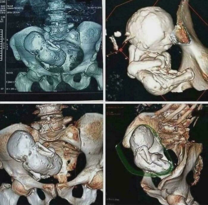 82-Year-Old Woman Discovers She’s Been Carrying A Calcified Baby For 40 Years