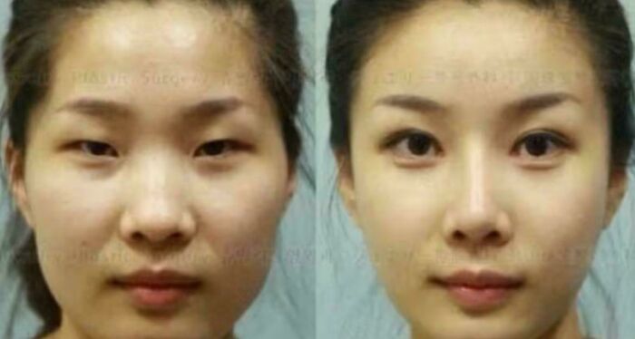 So Many Chinese Women Go To South Korea For Surgery That Officials Suggest Carrying A Doctor’s Note