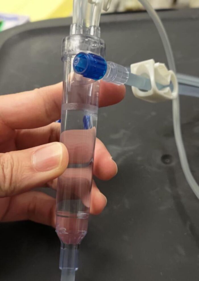 Dialysis Horror: Missing Filter That Could Cause Strokes!
