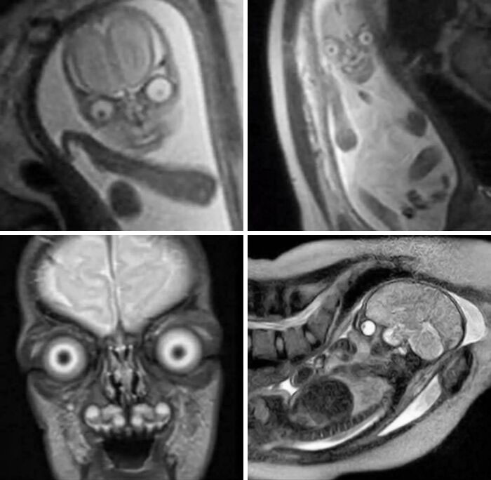 Why Pregnant Folks Get Ultrasounds Instead of MRIs: Because This Is What an MRI Fetus Looks Like!