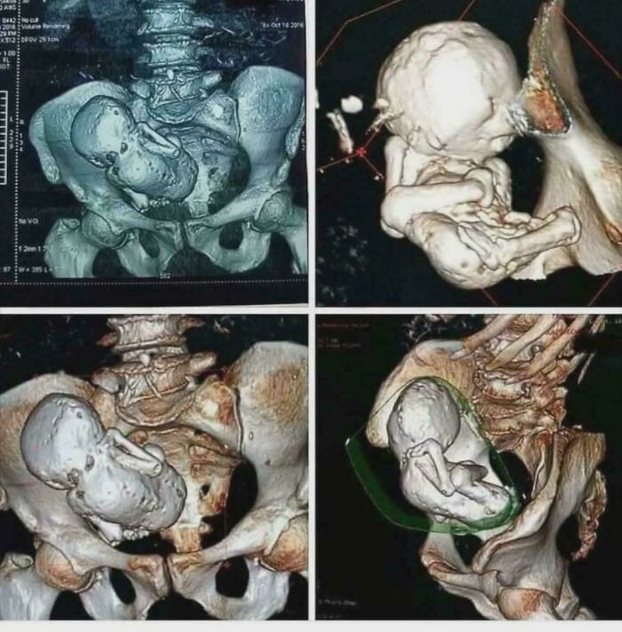 X-Ray Showing a 30-Year-Old Calcified Fetus—Whoa.