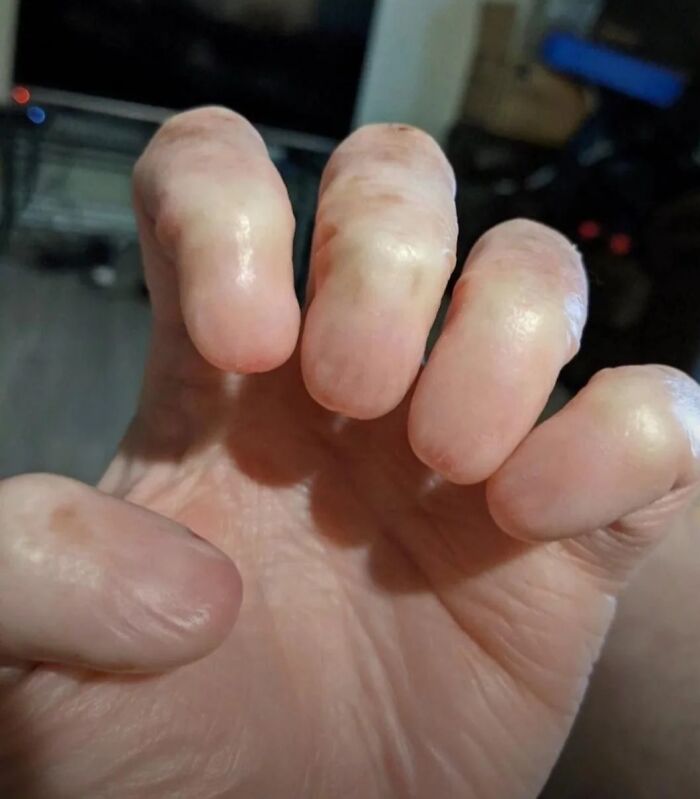 Anonychia: When Nails Are Playing Hide and Seek