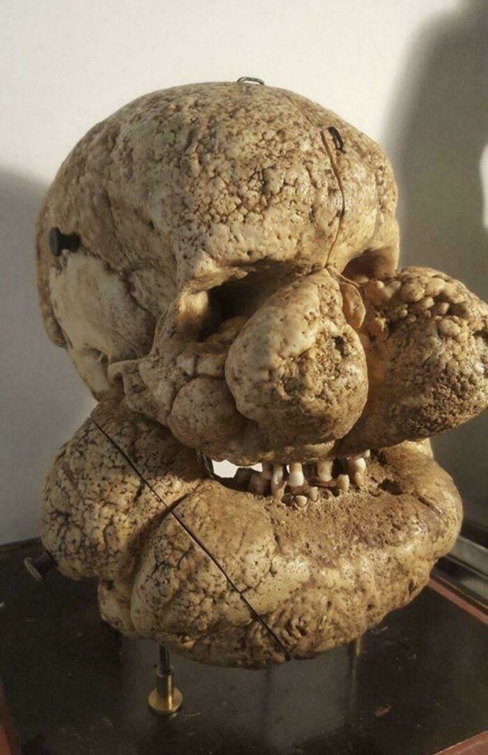 Skull from Someone with Proteus Syndrome—Weird But True!