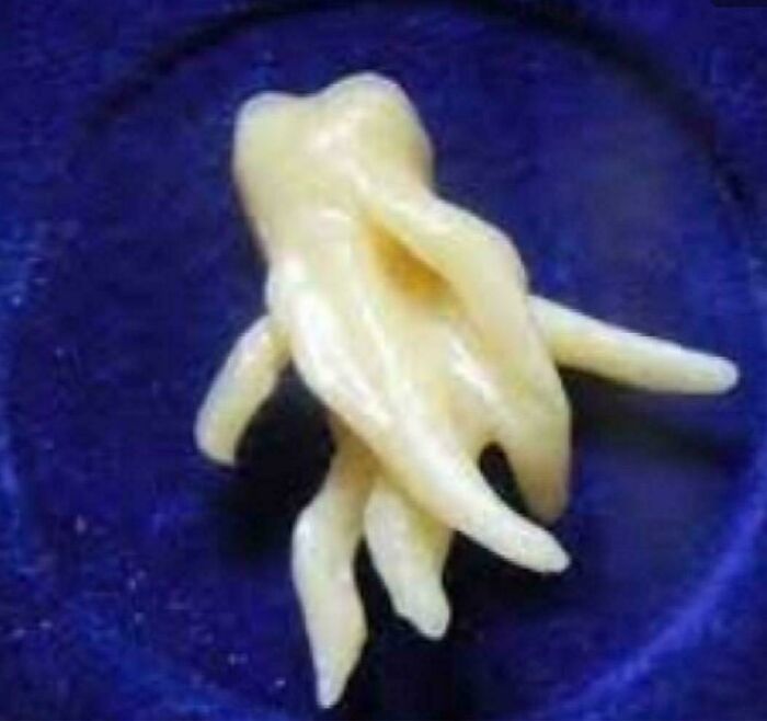 Someone’s Wisdom Tooth Looking Extra Weird Up Close!