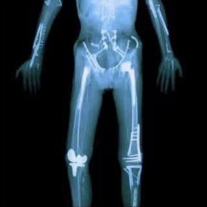 Travis Pastrana’s X-Ray. The Man Has Seriously Sacrificed His Body!