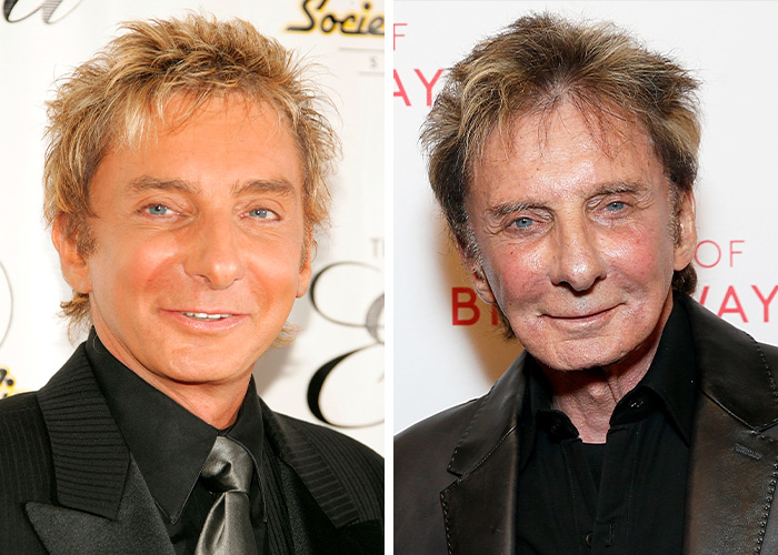 Barry Manilow’s Not-So-Secret Facelift