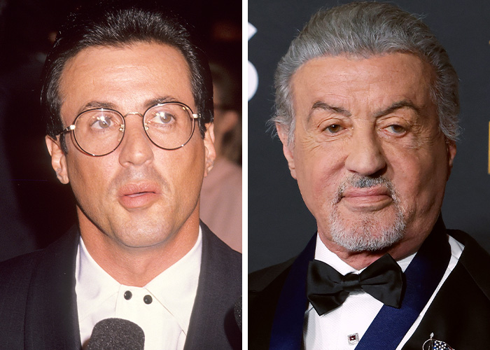 Sylvester Stallone’s Battle Scars (And Surgeries)