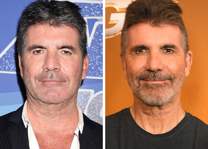 Simon Cowell’s Botox Wake-Up Call