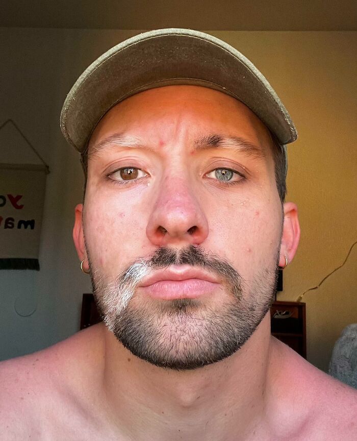 I Rock Vitiligo & Heterochromia — Double the Cool!