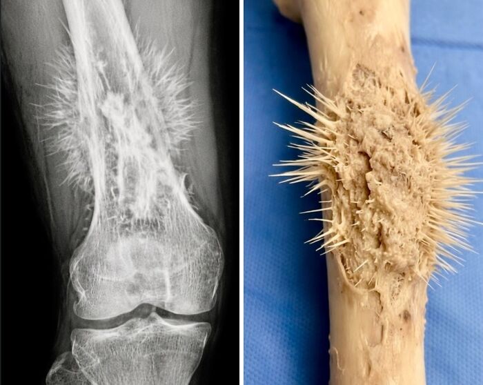 Osteosarcoma: Bone’s Spiky, Sunburst Nightmare