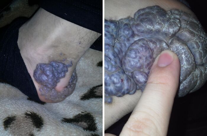 That’s My Heel’s Lifelong Party Spot — Meet My Hemangioma