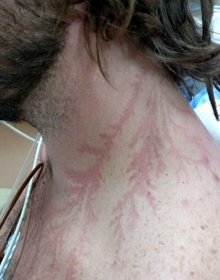 Hit by Lightning, Got a Cool Fractal Scar on My Neck!