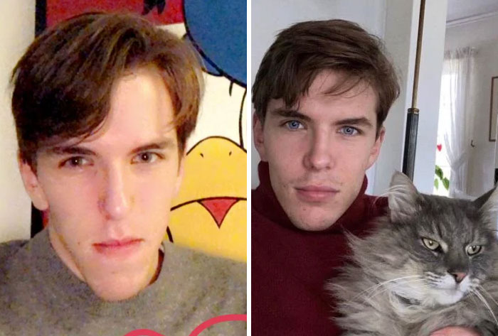 Double Jaw Surgery Glow Up – One Year Later