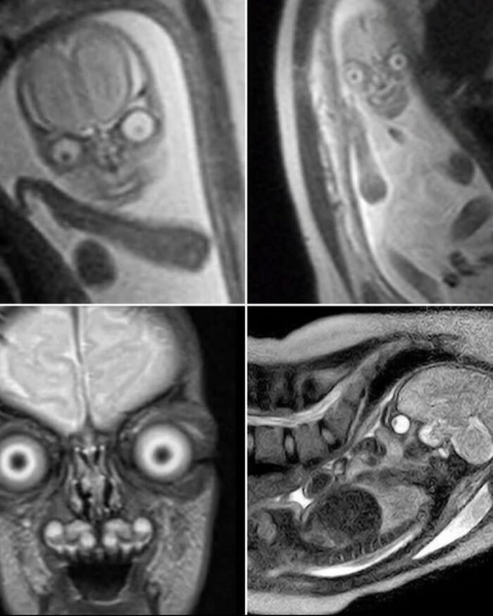 Why Pregnant Women Get Ultrasounds Instead Of MRIs? Here’s The Scoop