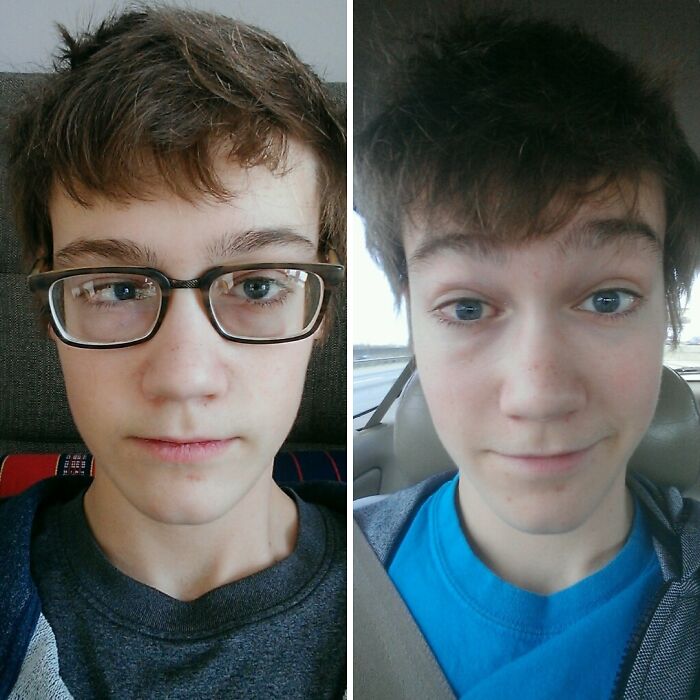 Cross-Eye Fix: Eye Surgery Before and 3 Weeks After Update!