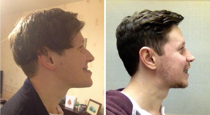 Jaw-Dropping! Double Jaw Surgery Before & After