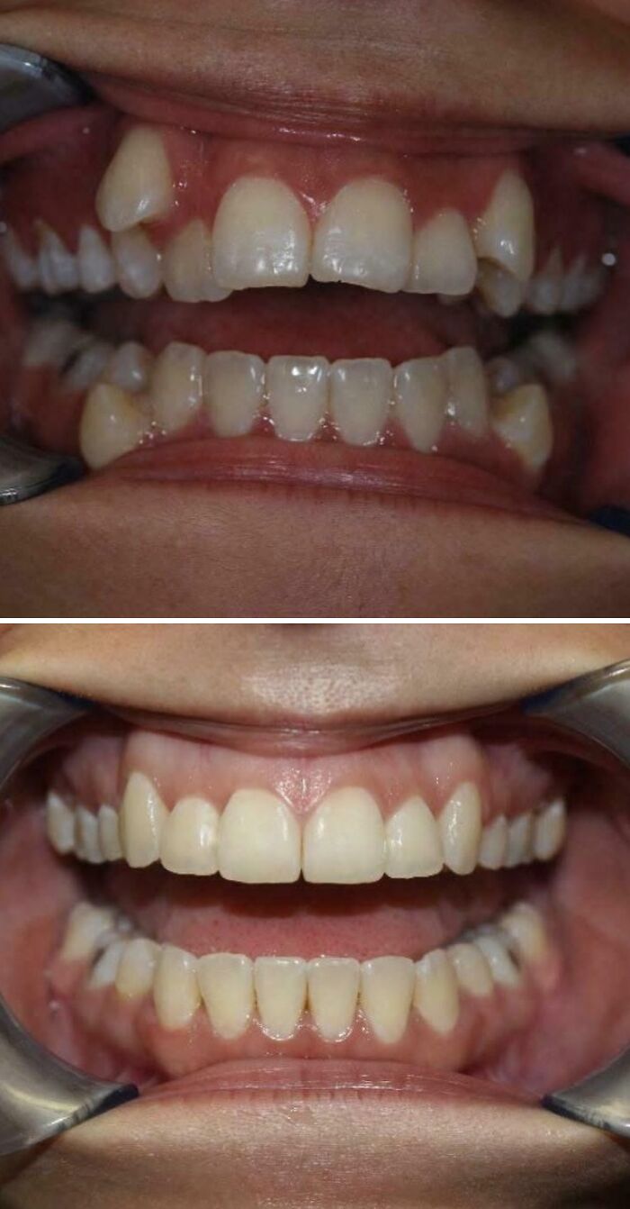 40+ Before-And-After Pics That Guess What? Actually Change A Lot!