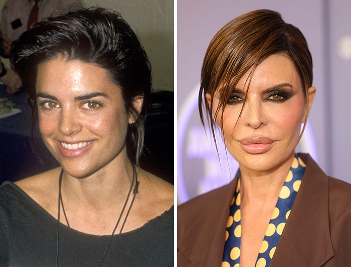 Lisa Rinna's Lip Filler Adventures