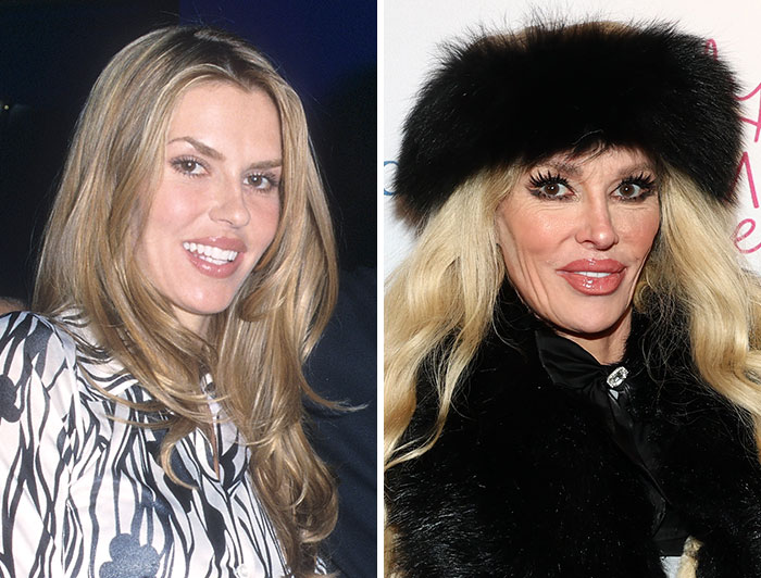 Brandi Glanville’s Bumpy Implant Nightmare