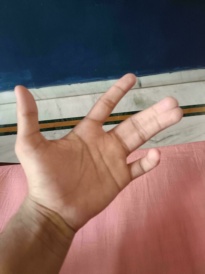 Syndactyly—The Condition Where Fingers Are Joined