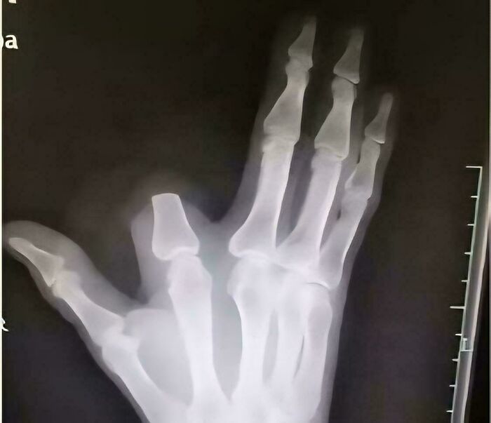 Man Chops Off Finger After Snake Bite... But It Wasn’t Venomous!