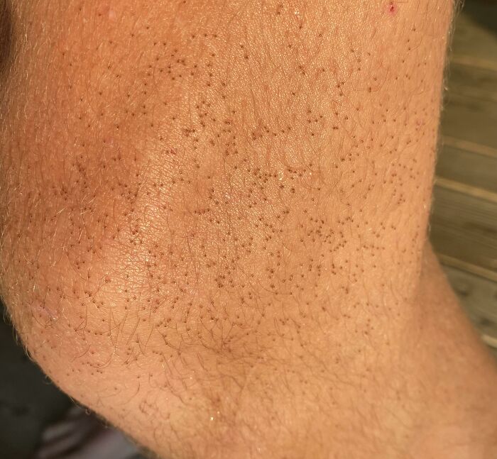 Walking Buddy Turns Out to Be Tiny Ticks (Gross!)
