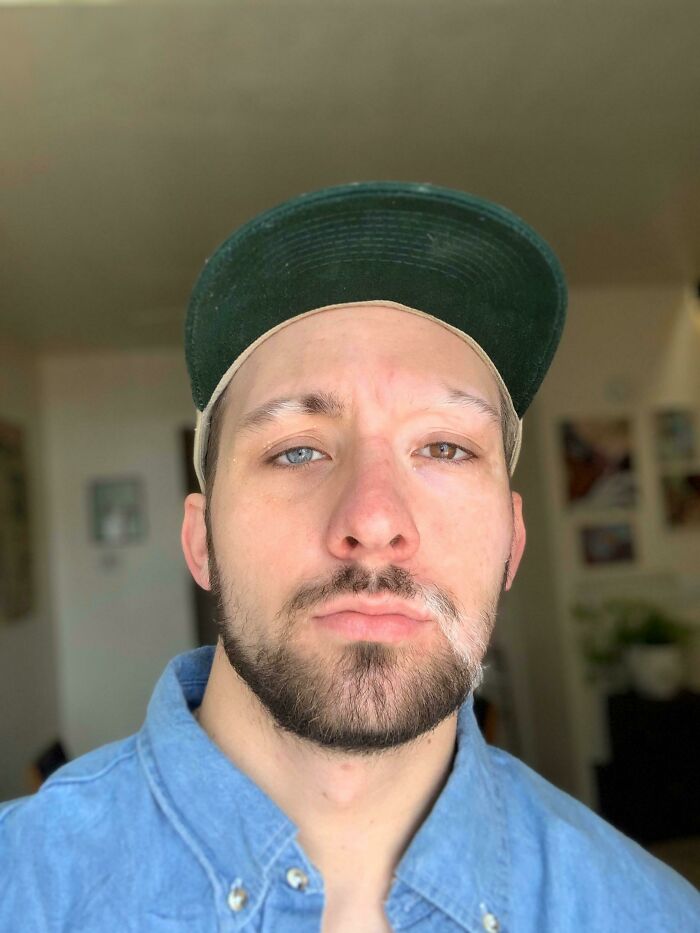 Mixing Vitiligo And Heterochromia Like A Boss