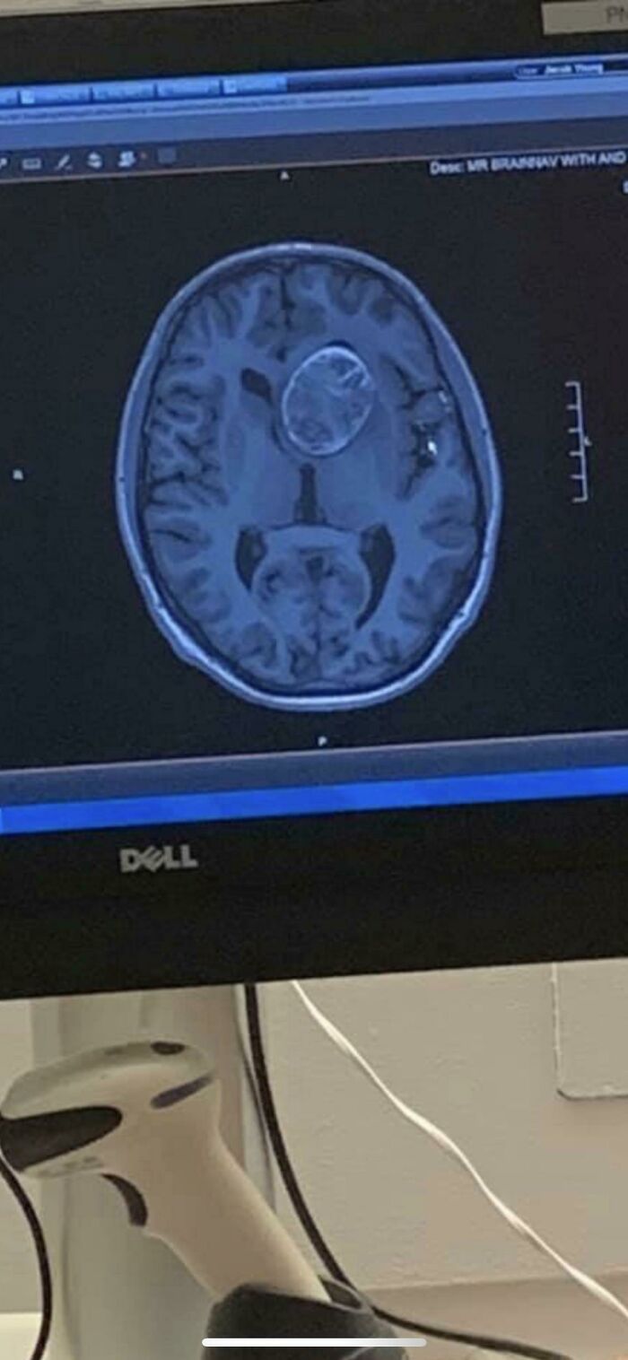 Brain + Giant Cyst = 22 Years of Amazing Adaptation