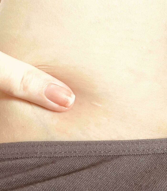 Friend’s Heart Surgery Scars Tell Brave Stories