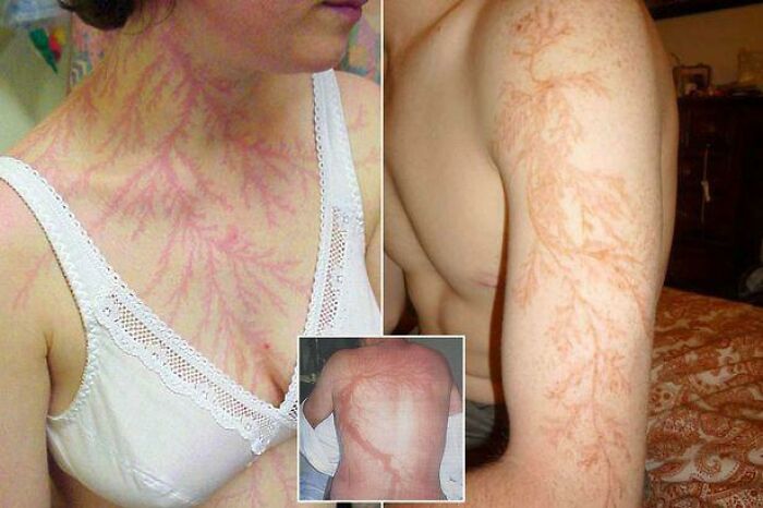 Lightning Strike Leaves Shockingly Cool Scars
