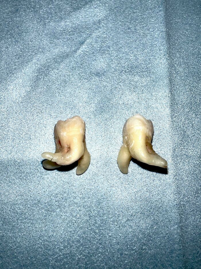 Just Got My Wisdom Teeth Out—Ow!