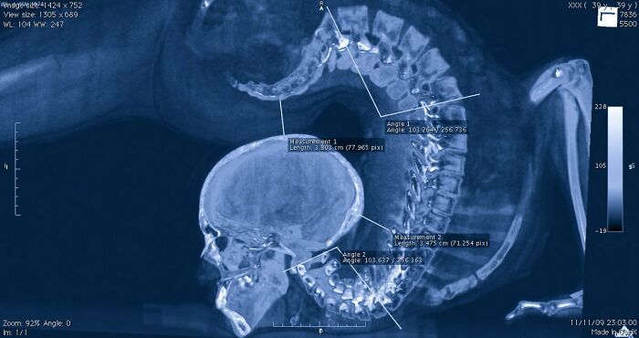 X-Ray Reveal: Contortionist’s Spine Does Some Bending Magic