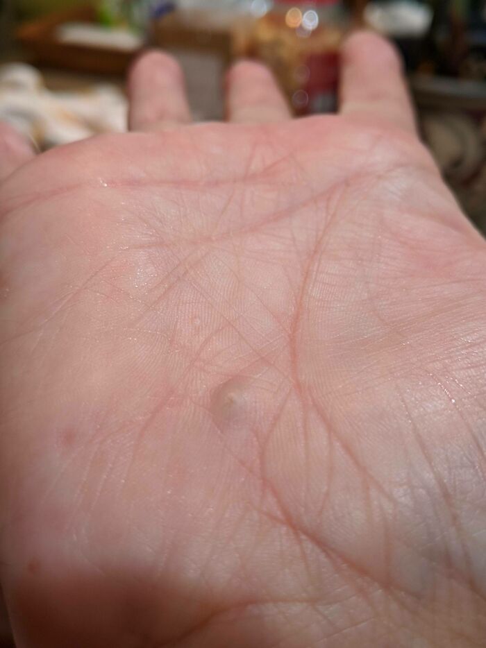 A Rock From a 25-Year-Old Bike Accident Slowly Popping Out