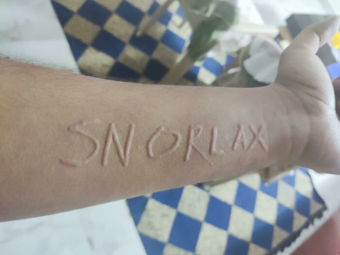 When Scratching Leaves Red Lines—Meet Dermatographia