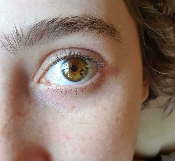 Freckles? In My Eyes? Heck Yes!