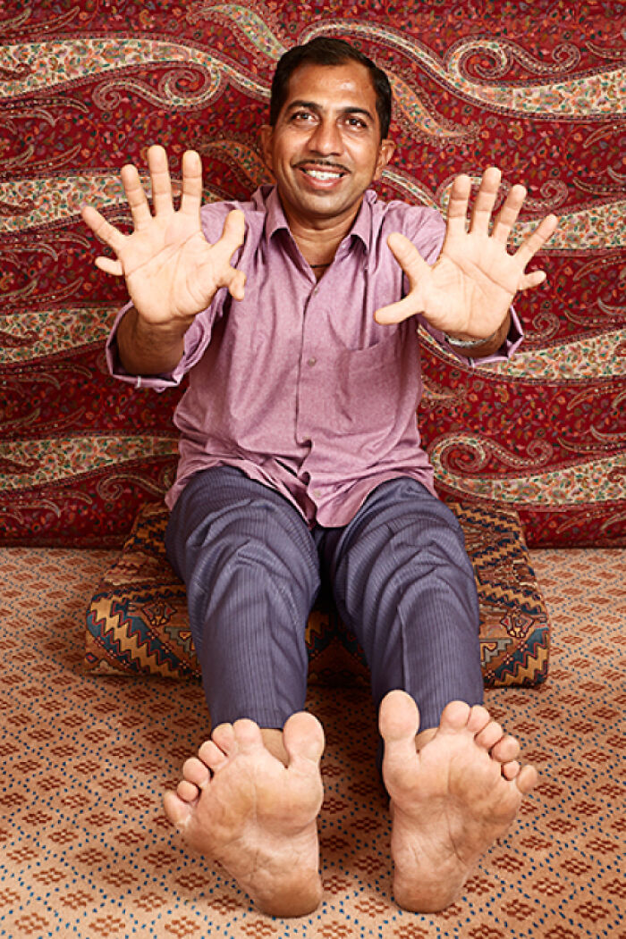 This Guy’s Got 14 Fingers and 14 Toes!