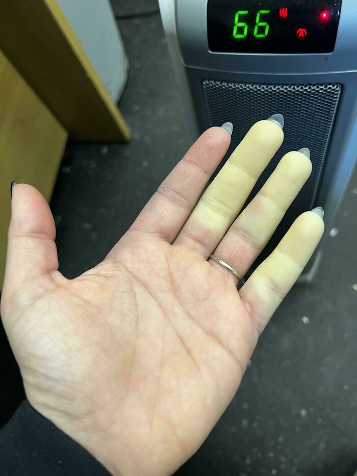 Raynaud’s Syndrome Making My Hand Look Like a Painting