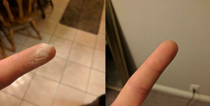 Look Ma, A New Fingertip—30 Days Later!