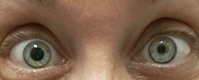 Box Fell On My Head and My Pupils Went All Different Sizes