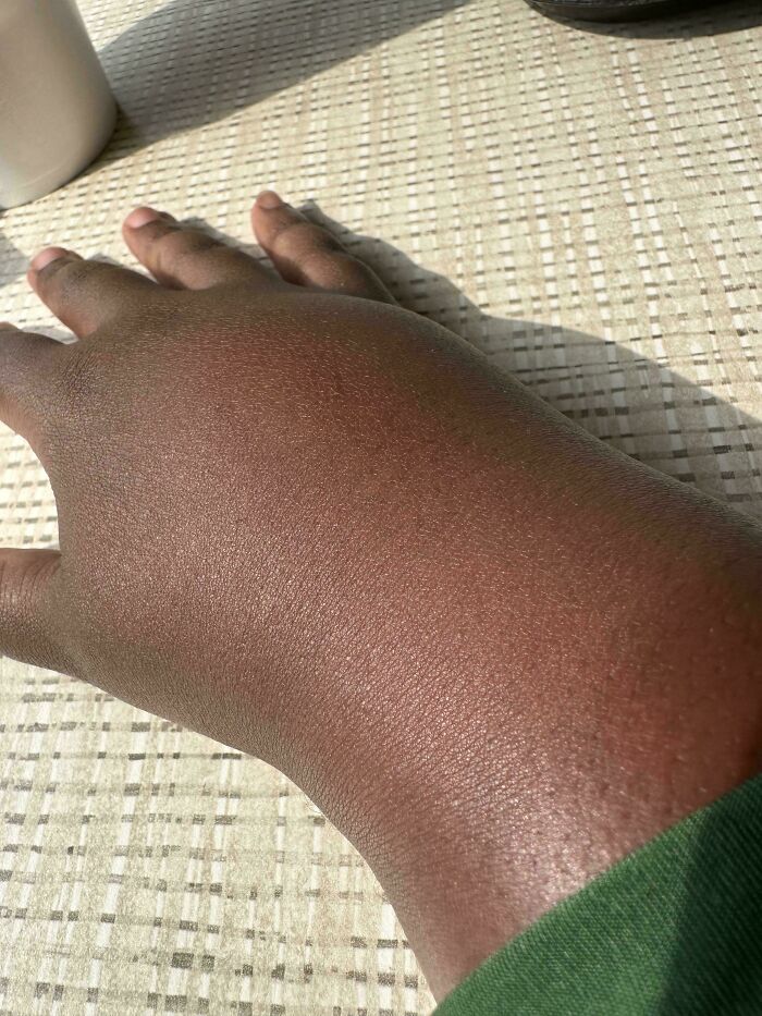 Wasp Sting? Instant Puffball!