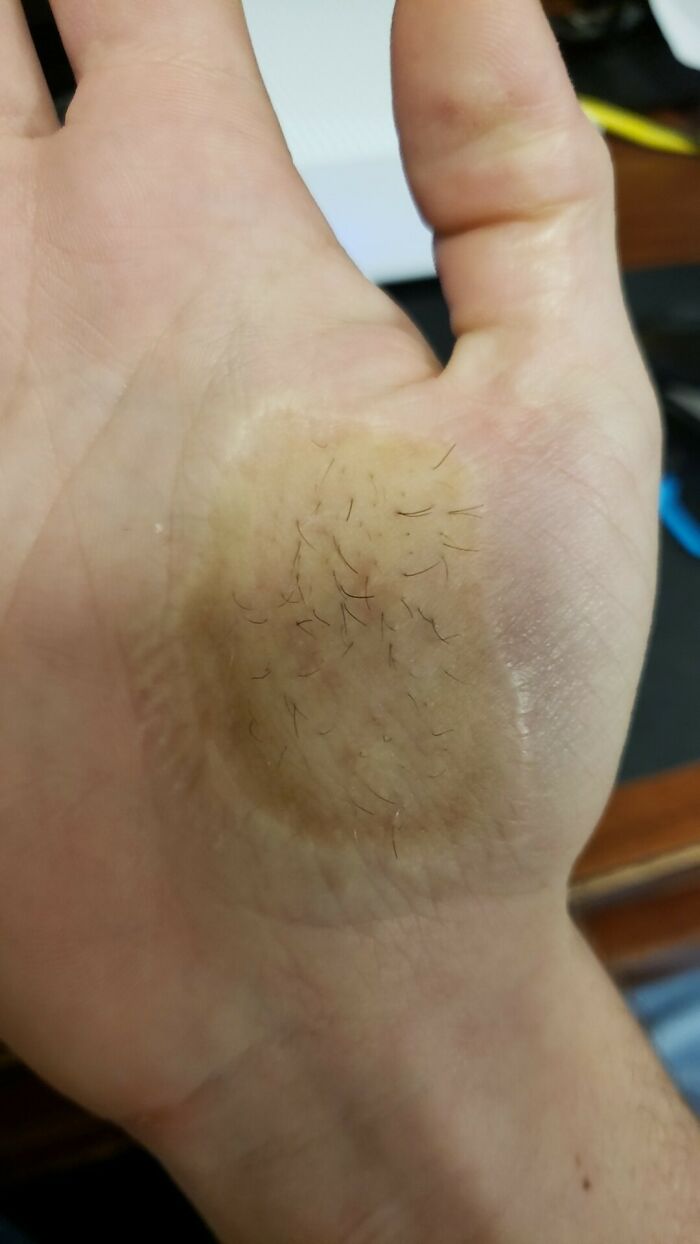 My Palm Grows Hair Thanks to a Skin Graft
