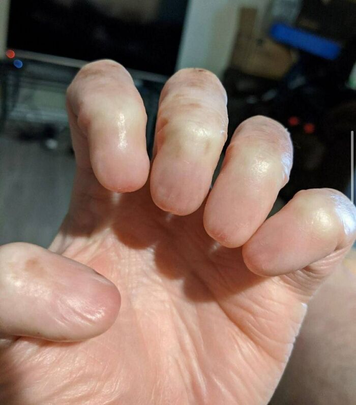 No Nails? Yup, It’s Called Anonychia