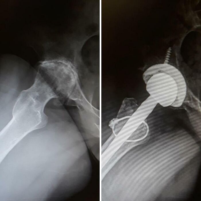 Before & After Hip Replacement Magic