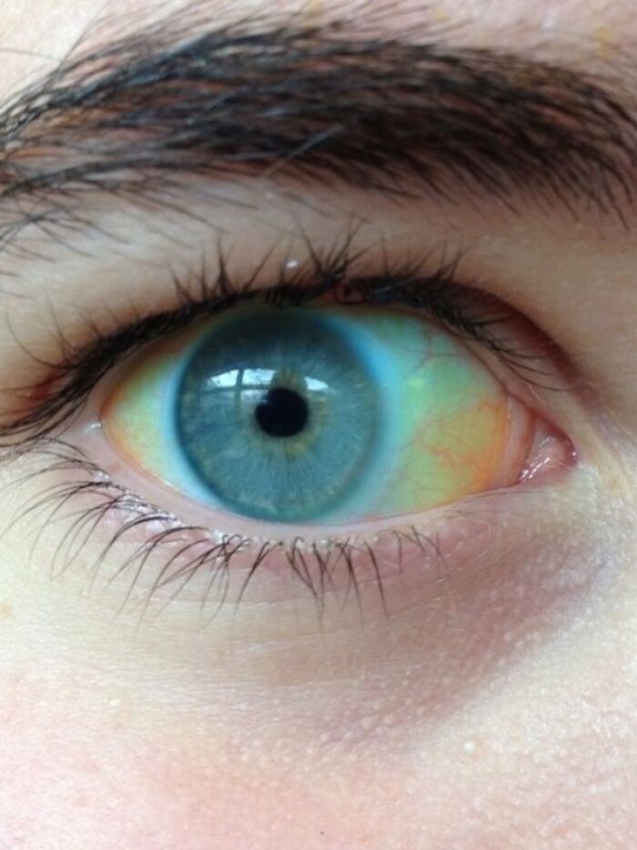 My Eye’s White Part Went Yellow—Here’s Why