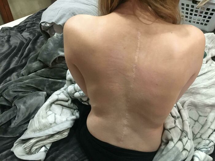 My Back and Scars From 2 Back Surgeries for Scoliosis