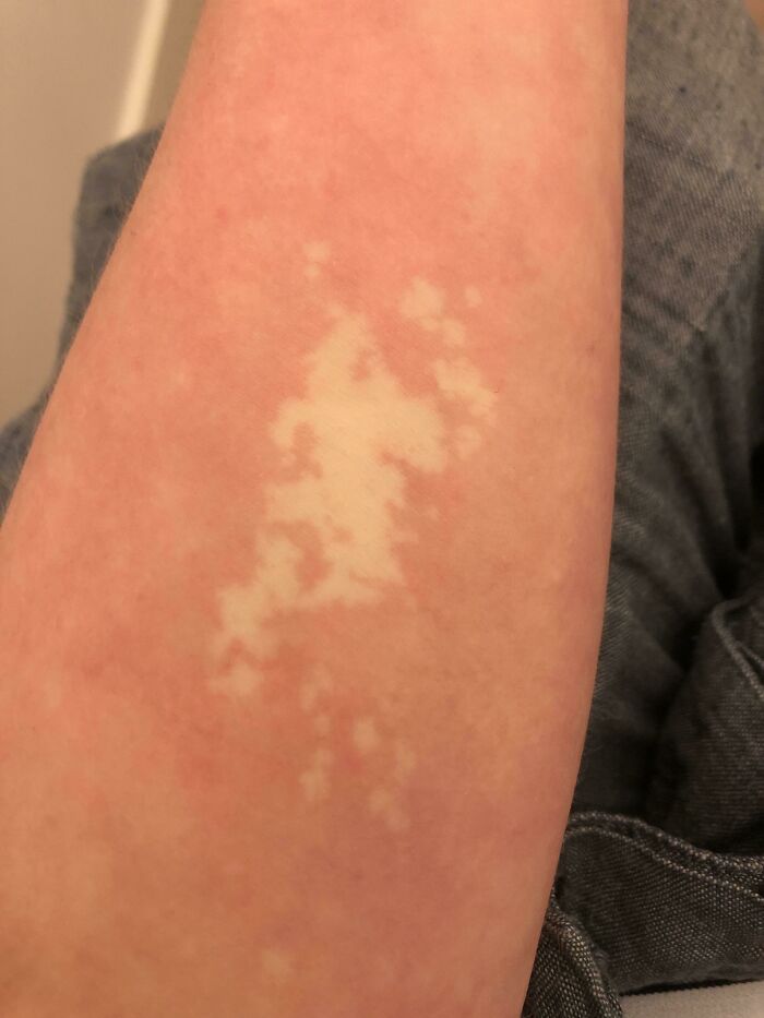 Jellyfish Sting 20 Years Ago Made My Skin Color Stay Same With Temperature