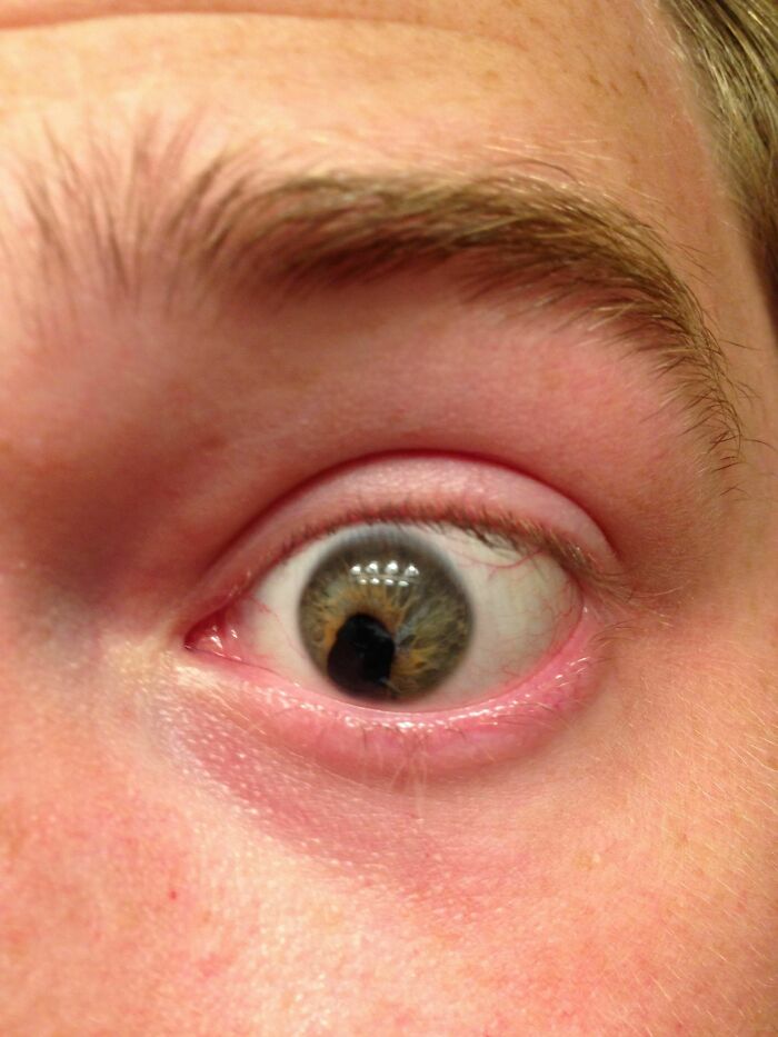 Stabbed In The Eye With A Hanger 11 Years Ago—Story Inside!