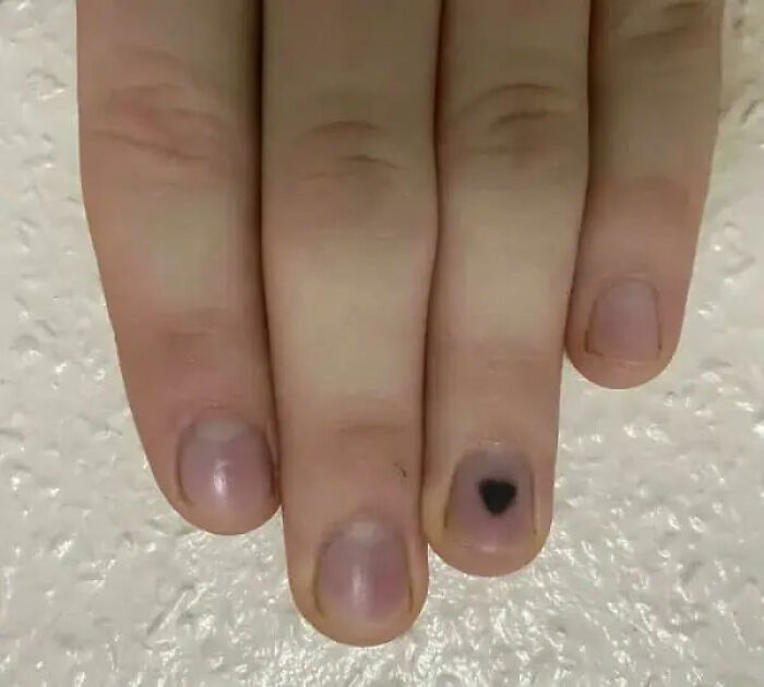 Blood Blister That Looks Like a Heart!