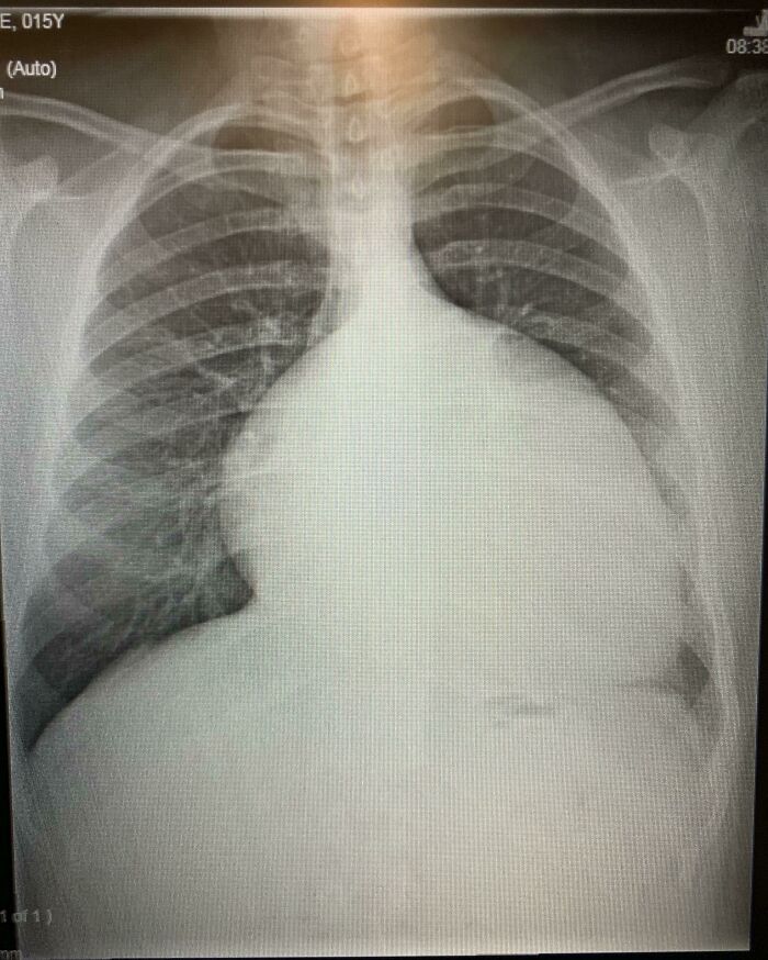 My Enlarged Heart Before Surgery at 15—Seriously!