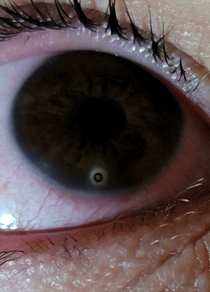 Metal in My Eye Left a Rust Ring After Falling Out